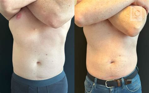 coolsclupting|coolsculpting antes e depois.